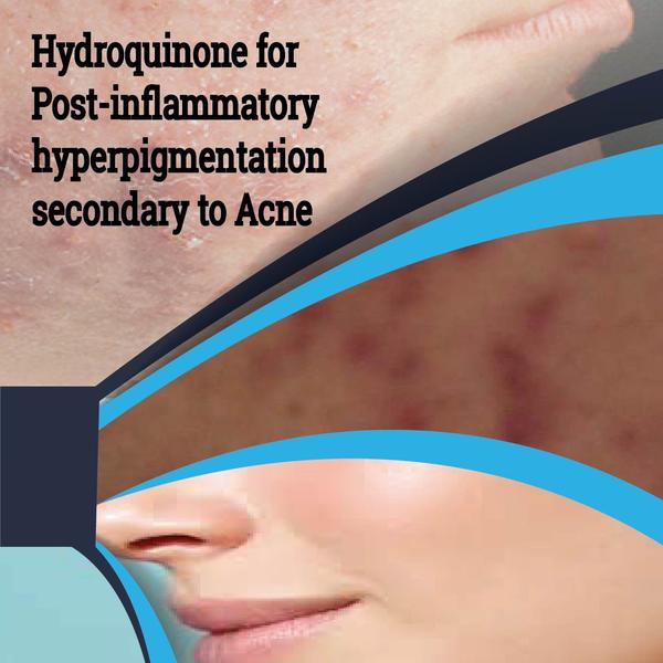 Hydroquinone for Post-inflammatory hyperpigmentation secondary to Acne – BiosenseClinic